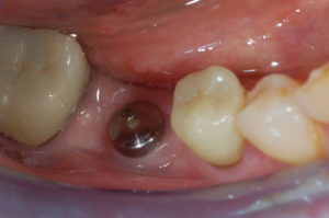 pose d'implant dentaire sur marseille 13001